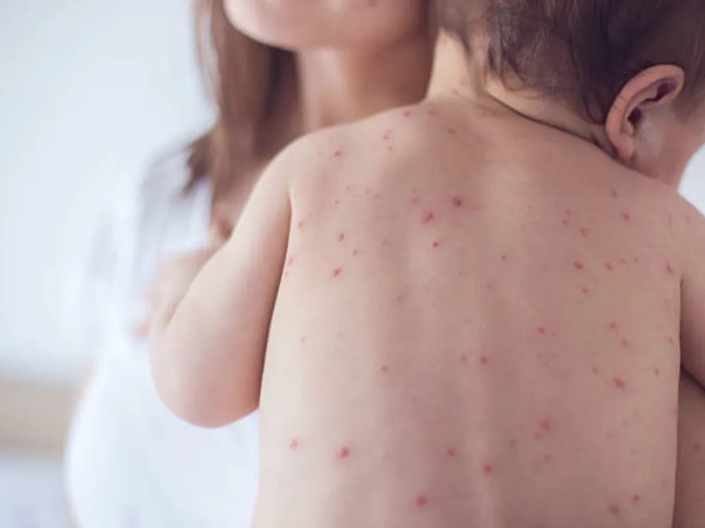 Alerjisi olanlara kızamık aşısı nasıl yapılmalı? 